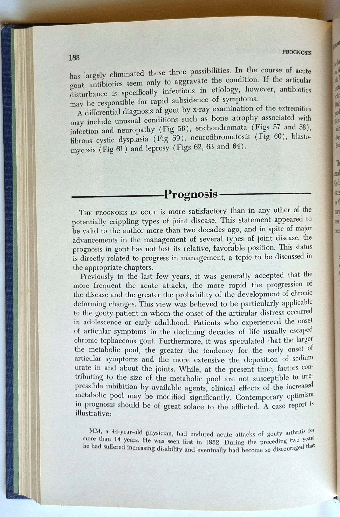 Gicht Zweite Auflage von John H. Talbott M.D. (Gut, 1964, gebunden, 261 Seiten, Grune & Stratton)