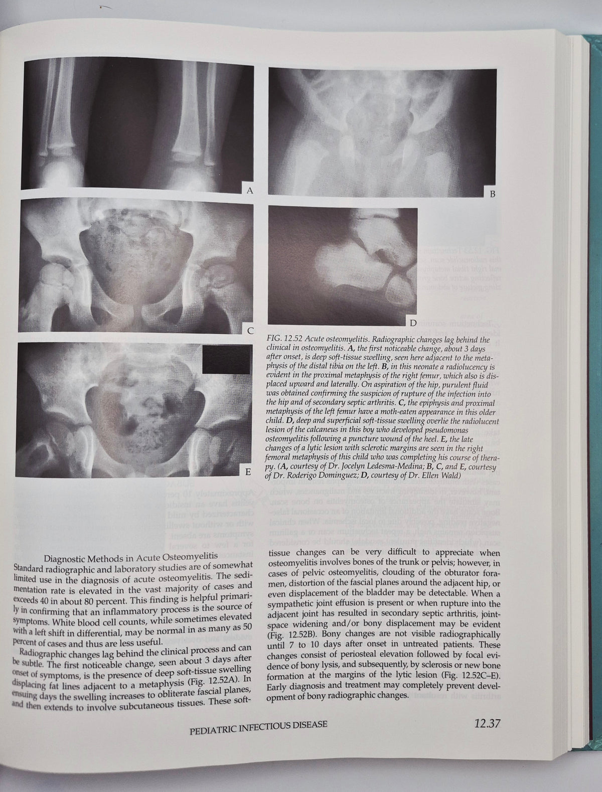 Atlas of Pediatric Physical Diagnosis 2nd edition edited by Basil J. Zitelli; Holly W. Davis (Very good, 1992, HC, Gower Medical Pub.)